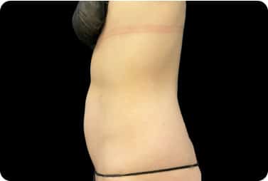 female abdominal fat after