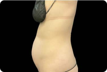 female abdominal fat before