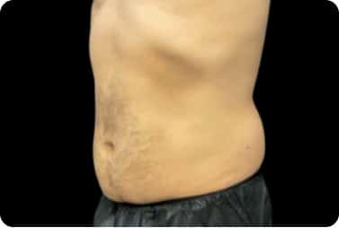 male abdominal fat after