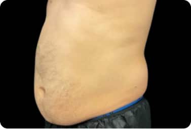 male abdominal fat before